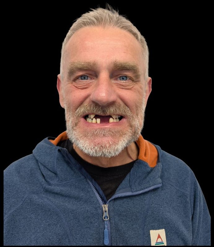 Patient before Same Day Teeth treatment at Hest Bank Dental Care